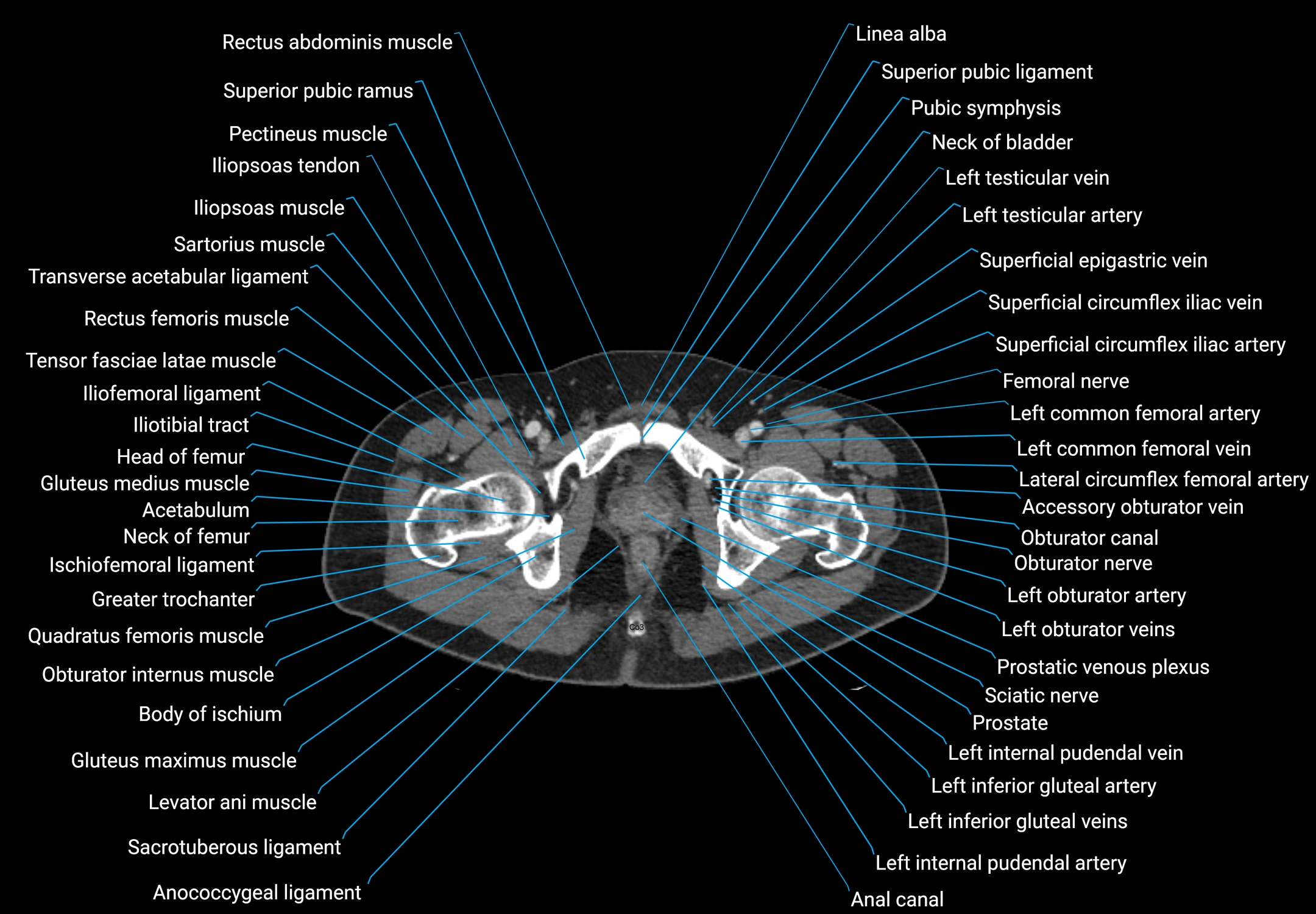 CT male pelvis axial cross sectional anatomy labelled radiology image -00195.webp